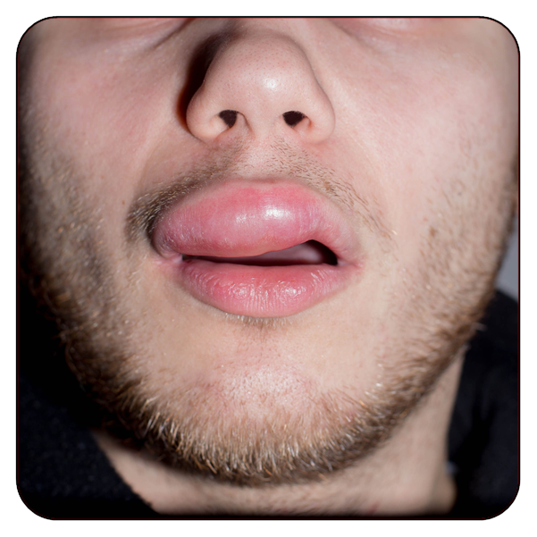 Treatment of Allergic and Nonallergic Angioedema