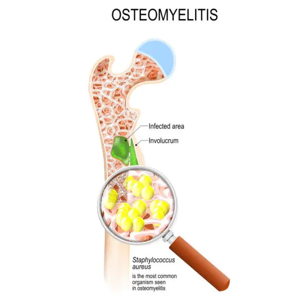 osteomyelitis