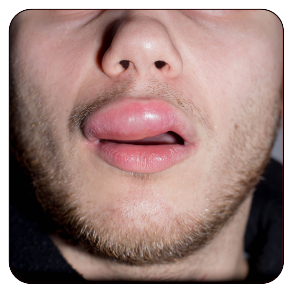 treatment-of-allergic-and-nonallergic-angioedema