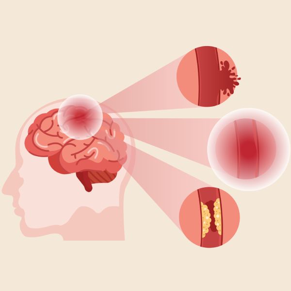 Stroke Care Today: From the ED to the ICU to the Floor and More